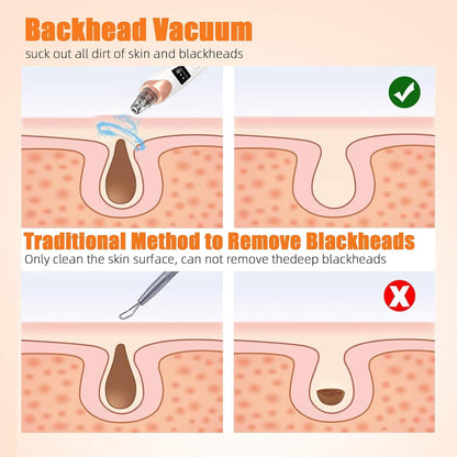USB Rechargeable Blackhead Remover Vacuum – 5 Suction Levels, 5 Probes, Professional Facial Pore Cleaner and Acne Extractor (White)
